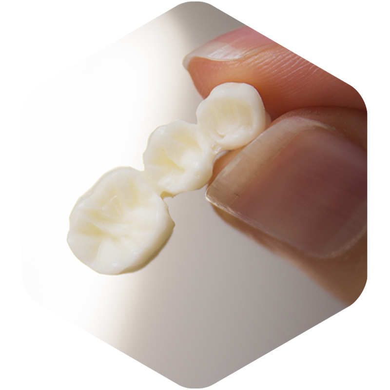 Dental bridge pictured